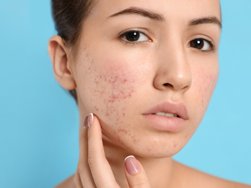 Acne Treatment