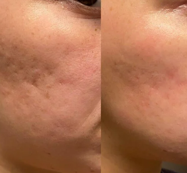 Blemish Mesotherapy İstanbul 2