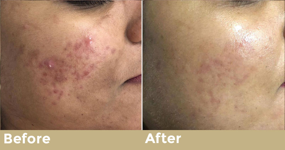 Blemish Mesotherapy İstanbul 4