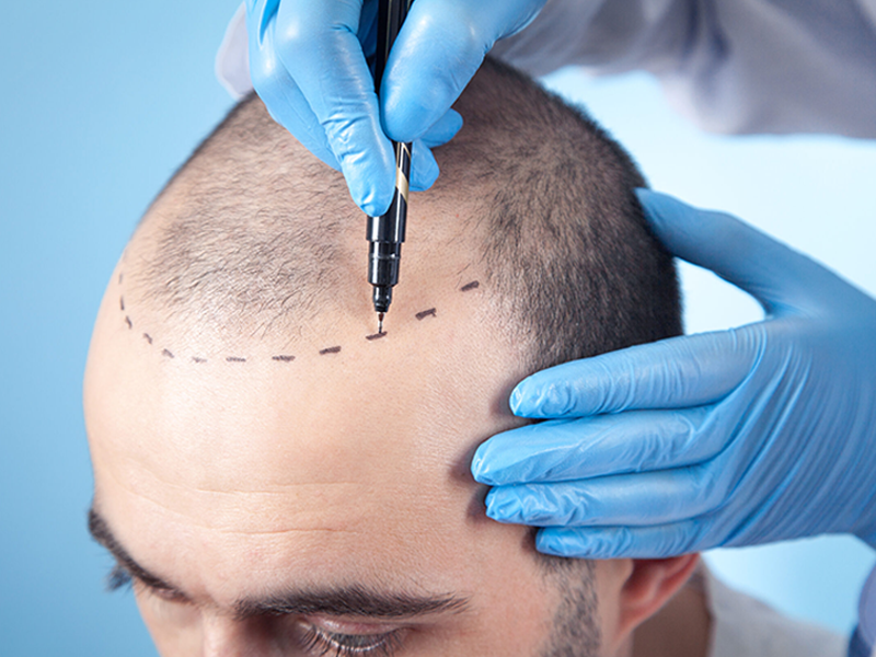 HAIR TRANSPLANT